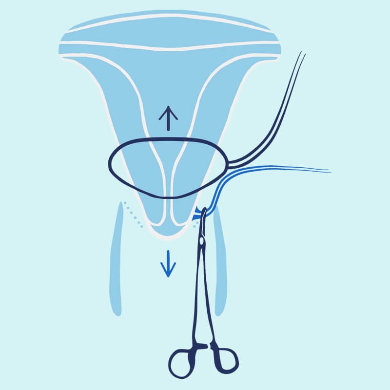Vaginal Hysterectomy Perth WA