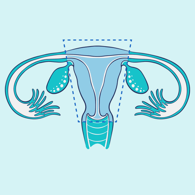 What is a hysterectomy