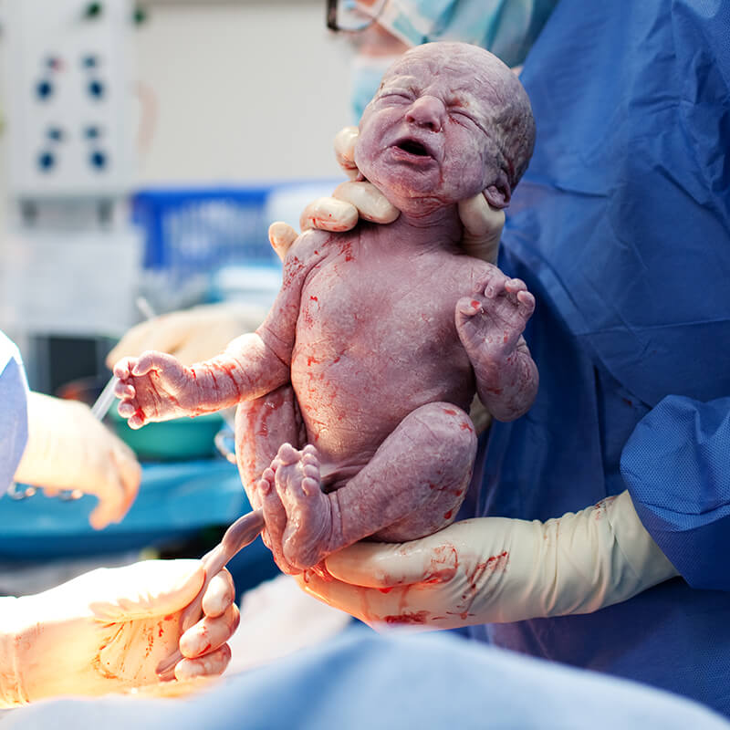 Natural birth vs c-section Perth WA